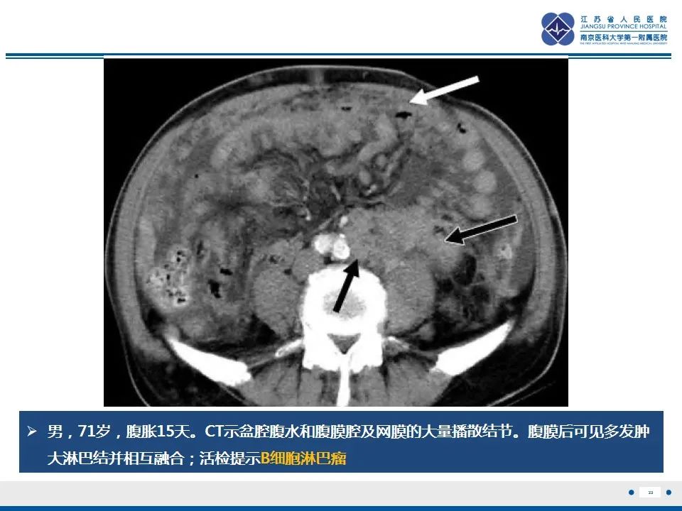 影像PPT - 【PPT】结核性腹膜炎-34
