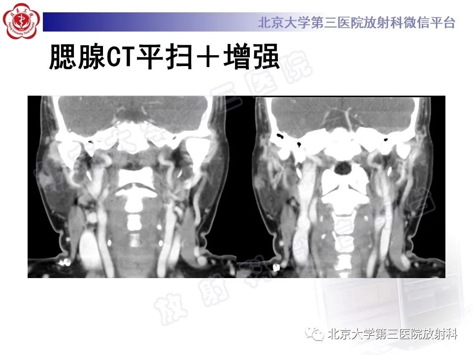 影像PPT - 【PPT】腮腺粘液表皮样癌-4