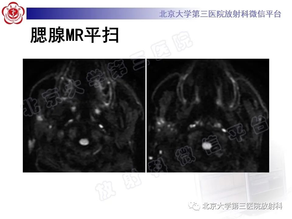 影像PPT - 【PPT】腮腺粘液表皮样癌-7