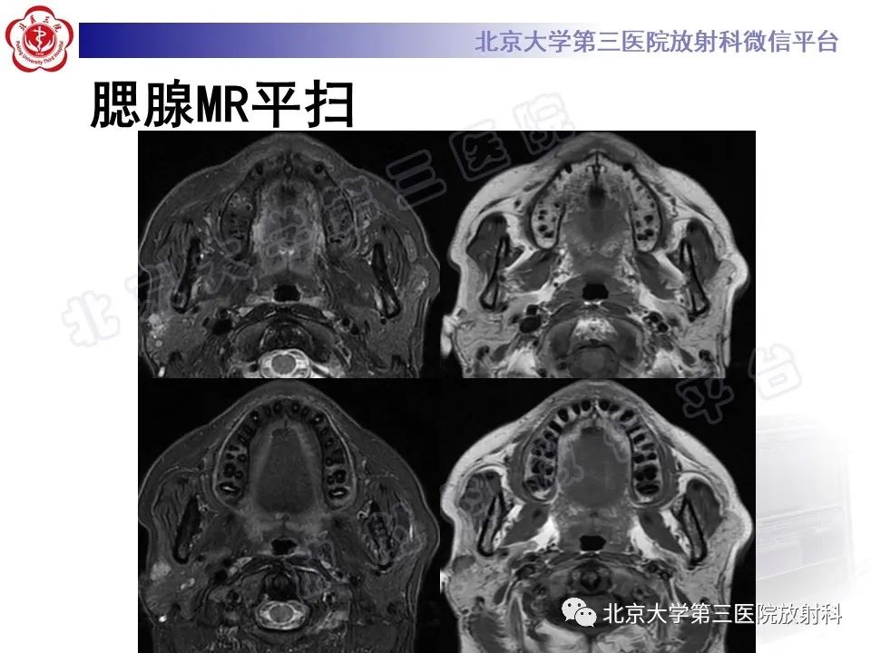 影像PPT - 【PPT】腮腺粘液表皮样癌-5