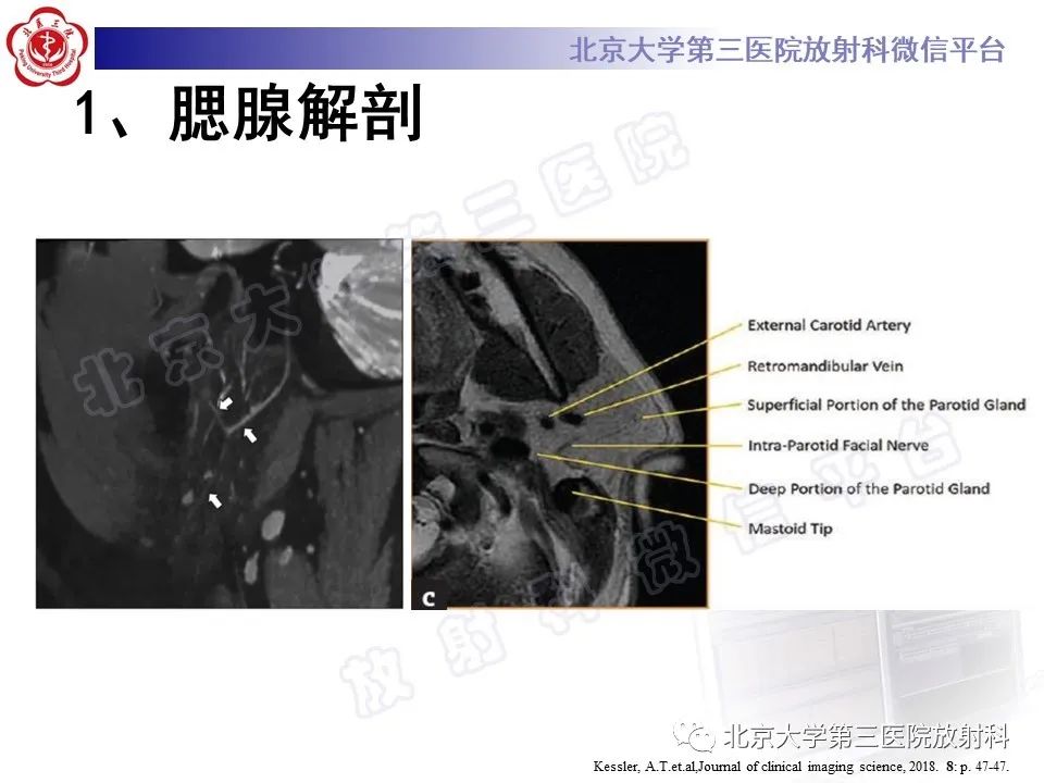 影像PPT - 【PPT】腮腺粘液表皮样癌-12