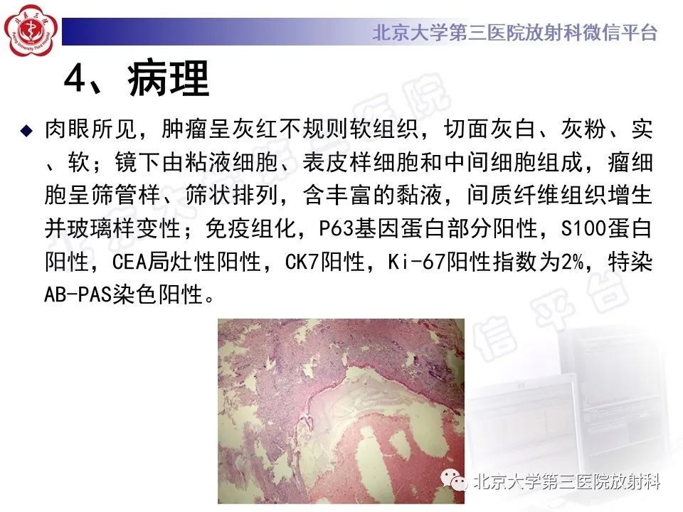 影像PPT - 【PPT】腮腺粘液表皮样癌-16