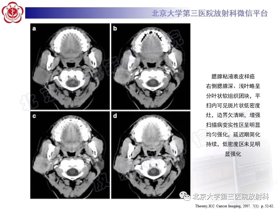 影像PPT - 【PPT】腮腺粘液表皮样癌-20