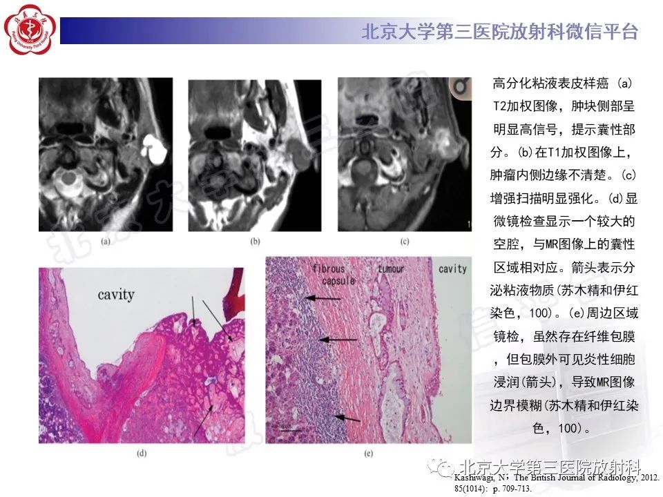 影像PPT - 【PPT】腮腺粘液表皮样癌-21