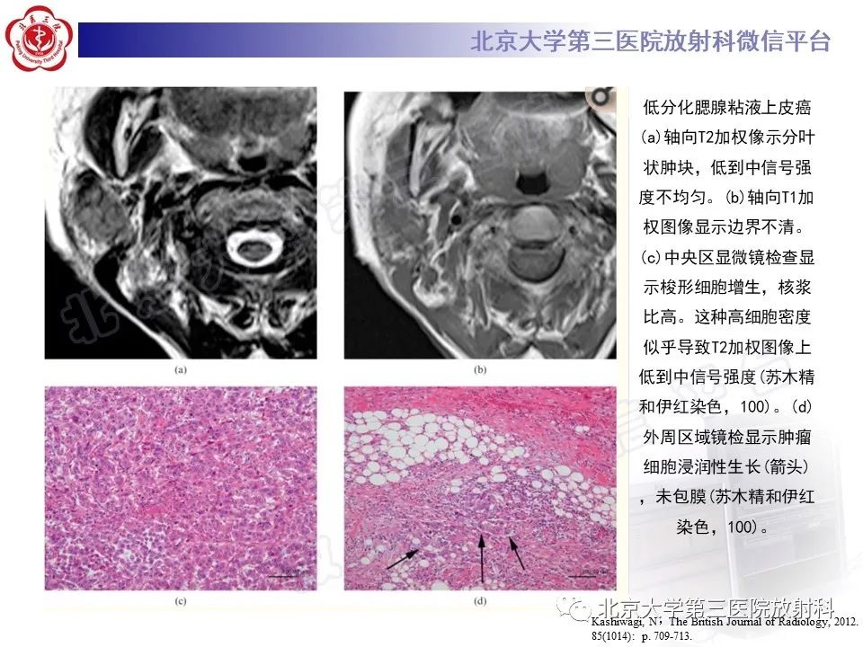 影像PPT - 【PPT】腮腺粘液表皮样癌-23