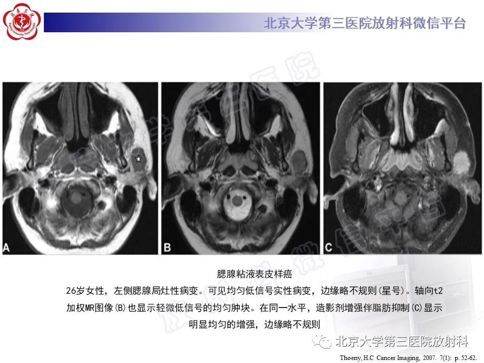 影像PPT - 【PPT】腮腺粘液表皮样癌-24