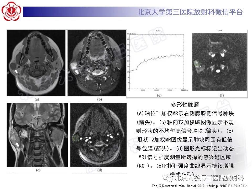 影像PPT - 【PPT】腮腺粘液表皮样癌-27