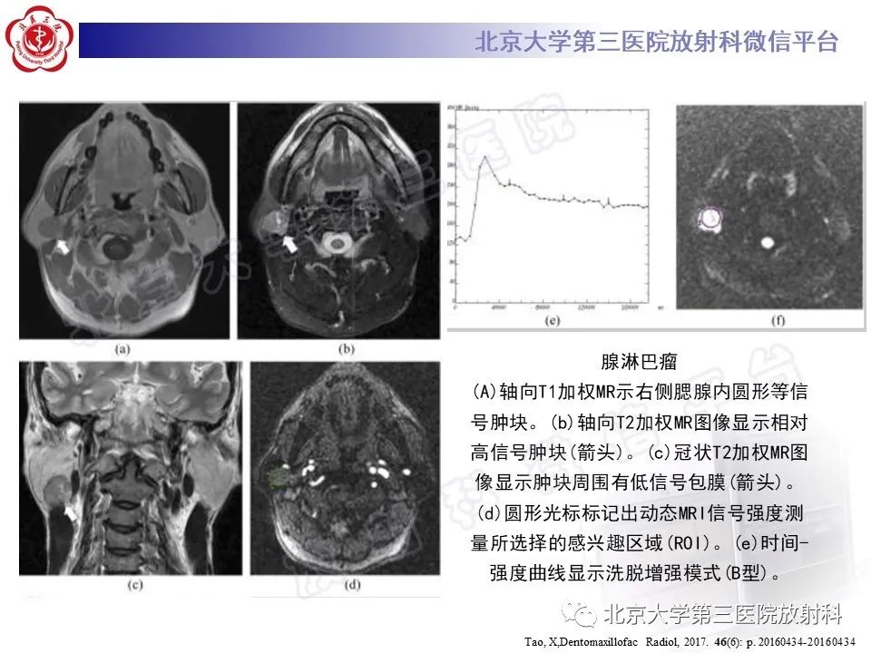 影像PPT - 【PPT】腮腺粘液表皮样癌-29