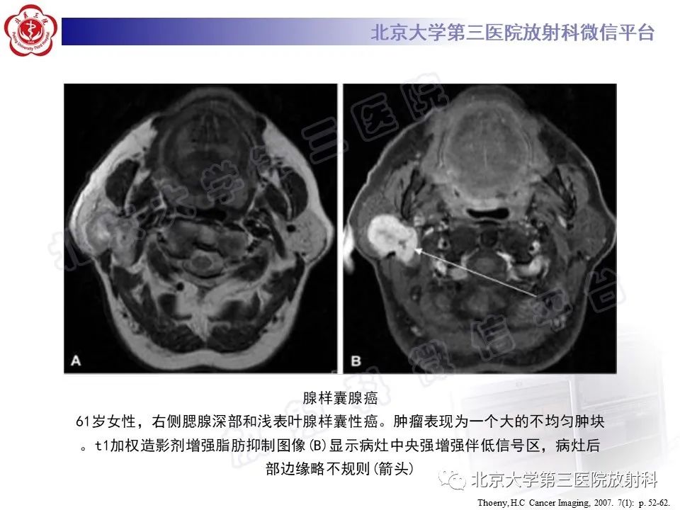 影像PPT - 【PPT】腮腺粘液表皮样癌-31