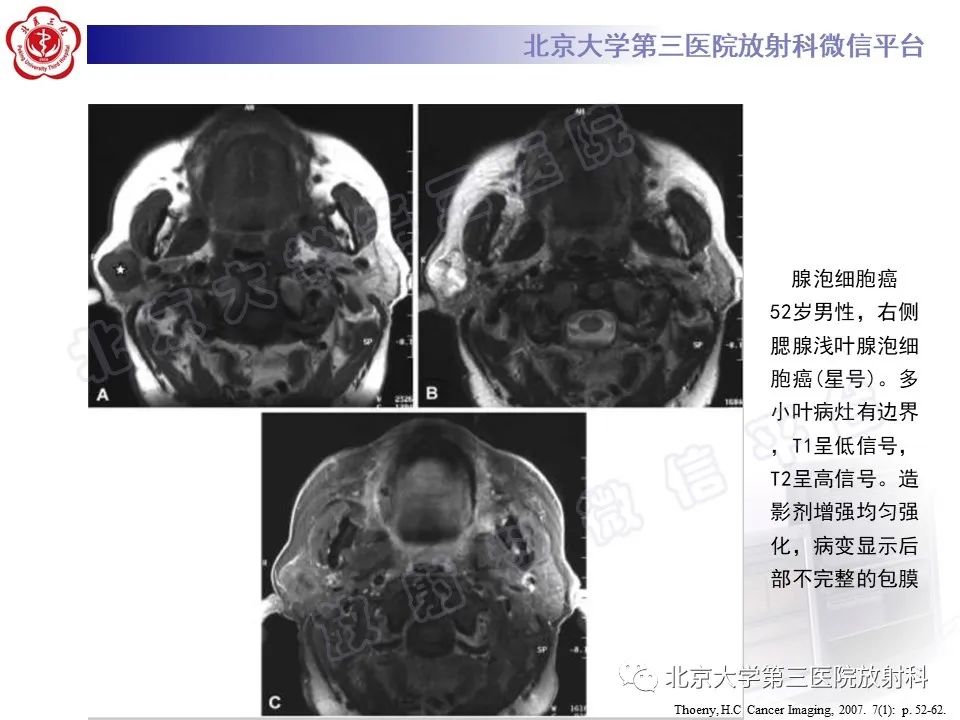 影像PPT - 【PPT】腮腺粘液表皮样癌-33