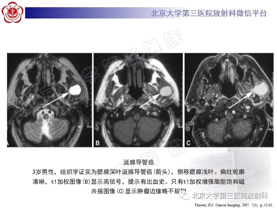 影像PPT - 【PPT】腮腺粘液表皮样癌-35