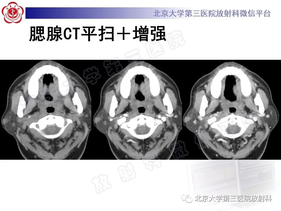 影像PPT - 【PPT】腮腺粘液表皮样癌-1