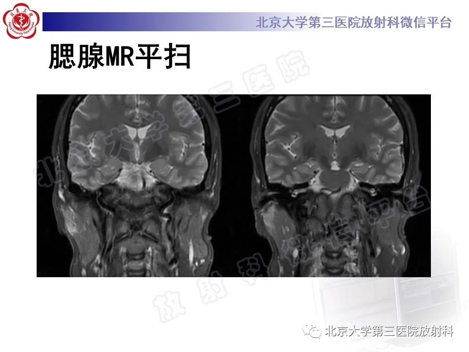 影像PPT - 【PPT】腮腺粘液表皮样癌-2