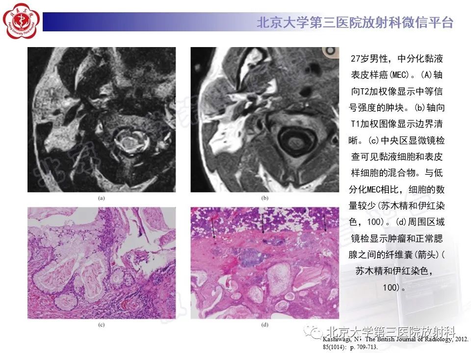 影像PPT - 【PPT】腮腺粘液表皮样癌-3