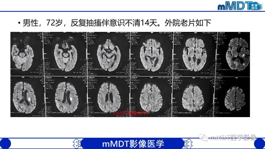 影像PPT - 【PPT】两例脑膜强化的隐球菌及综述-2