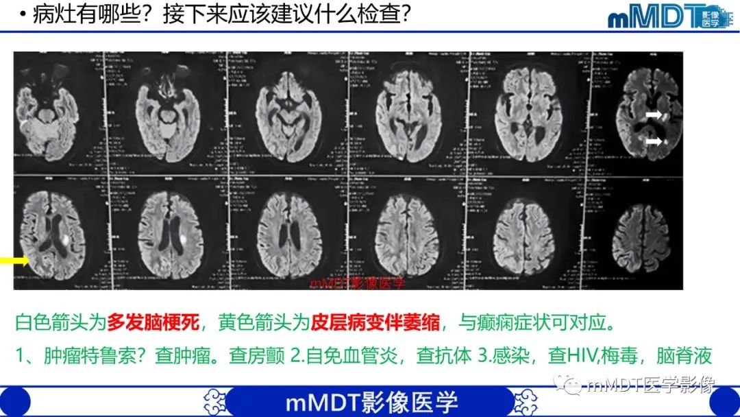 影像PPT - 【PPT】两例脑膜强化的隐球菌及综述-3