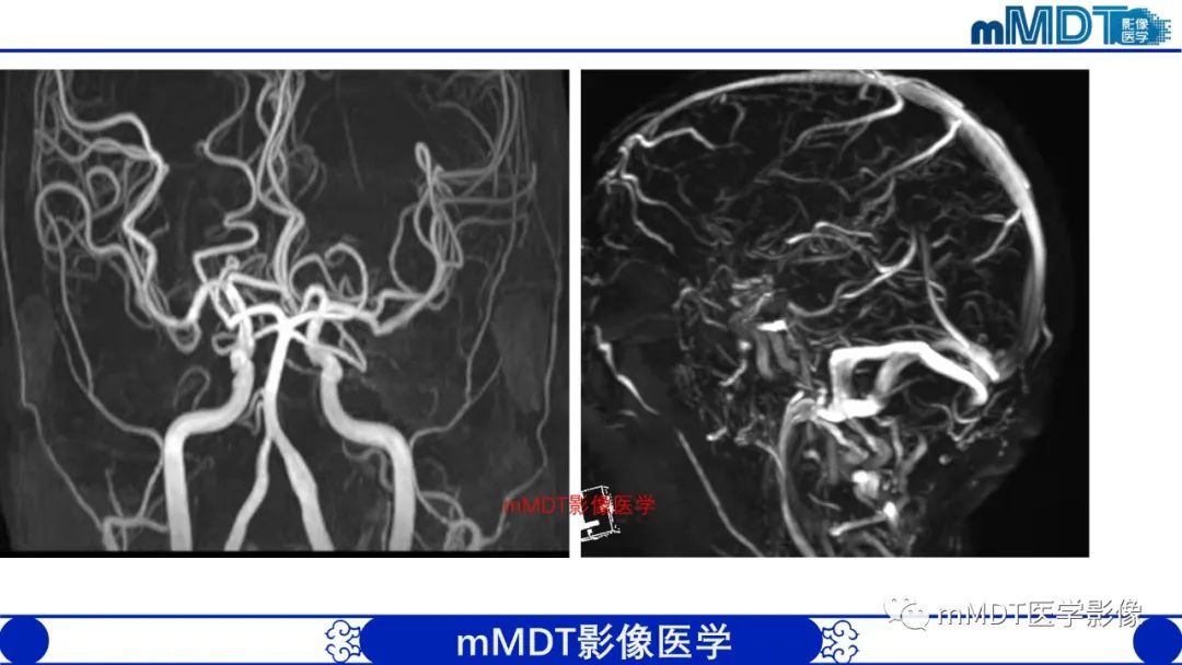 影像PPT - 【PPT】两例脑膜强化的隐球菌及综述-8