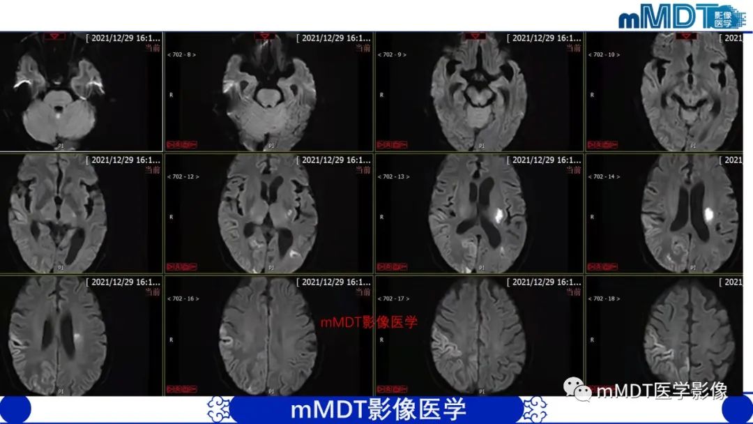 影像PPT - 【PPT】两例脑膜强化的隐球菌及综述-7