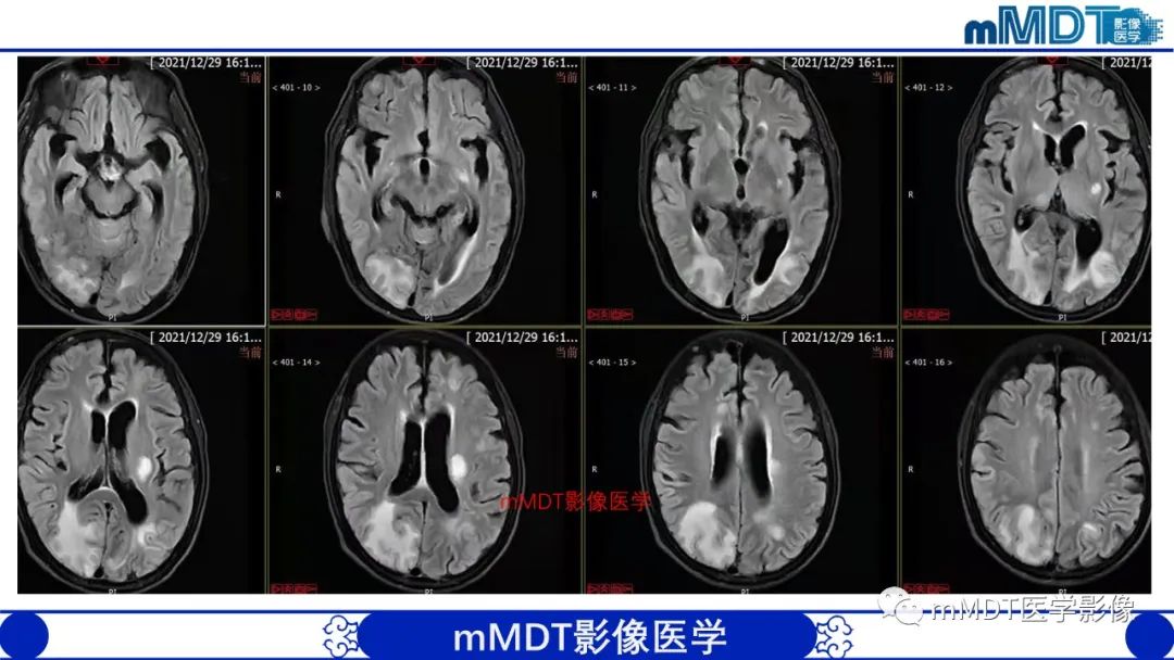 影像PPT - 【PPT】两例脑膜强化的隐球菌及综述-6