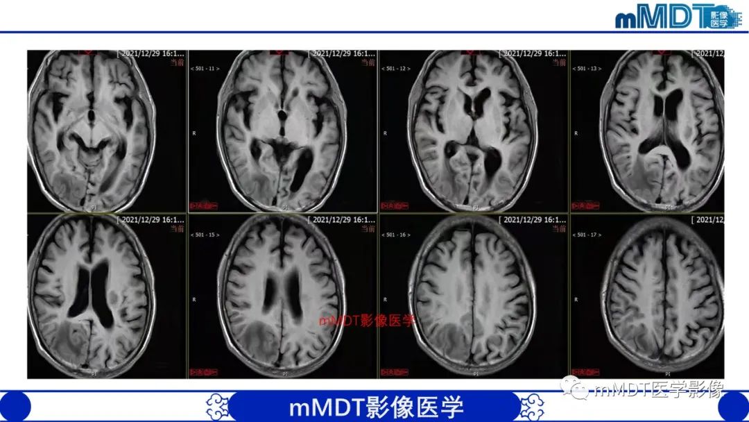 影像PPT - 【PPT】两例脑膜强化的隐球菌及综述-5