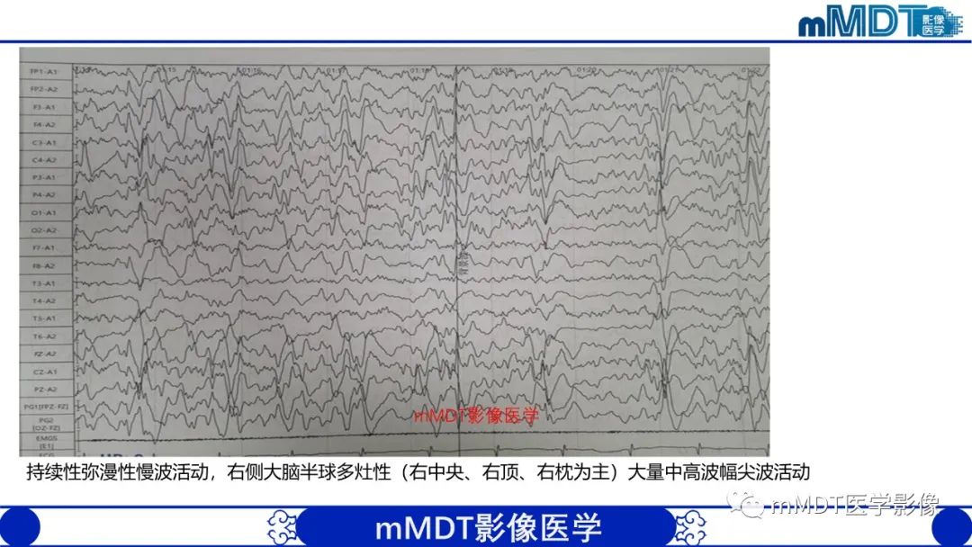 影像PPT - 【PPT】两例脑膜强化的隐球菌及综述-9