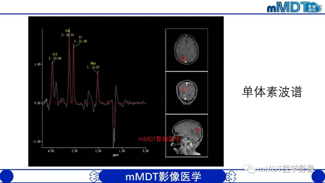 影像PPT - 【PPT】两例脑膜强化的隐球菌及综述-12