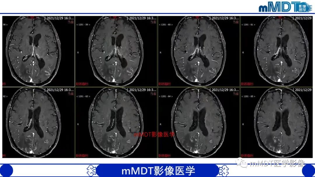 影像PPT - 【PPT】两例脑膜强化的隐球菌及综述-18