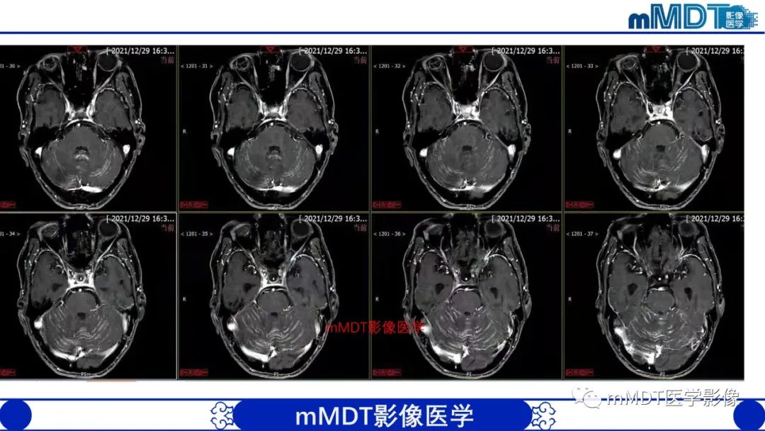 影像PPT - 【PPT】两例脑膜强化的隐球菌及综述-19