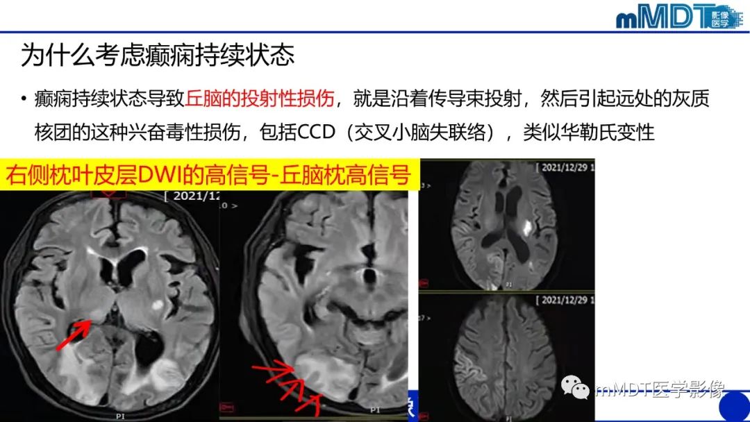 影像PPT - 【PPT】两例脑膜强化的隐球菌及综述-16