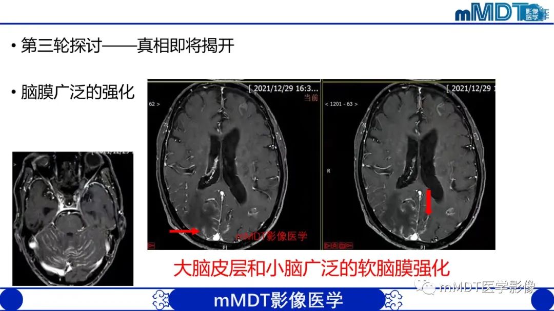 影像PPT - 【PPT】两例脑膜强化的隐球菌及综述-20