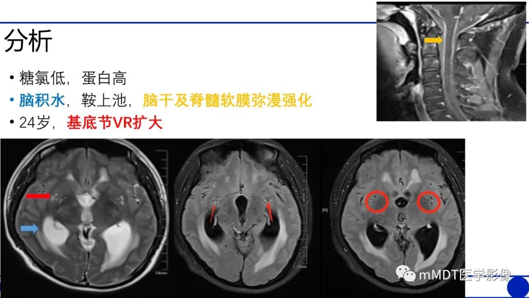 影像PPT - 【PPT】两例脑膜强化的隐球菌及综述-33