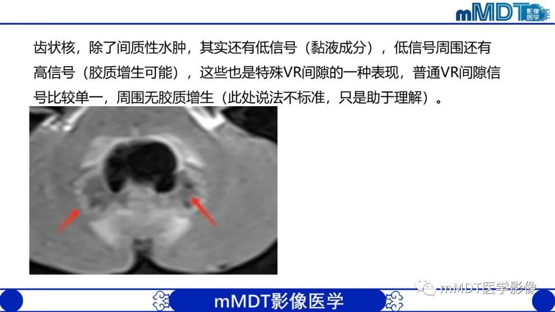 影像PPT - 【PPT】两例脑膜强化的隐球菌及综述-34