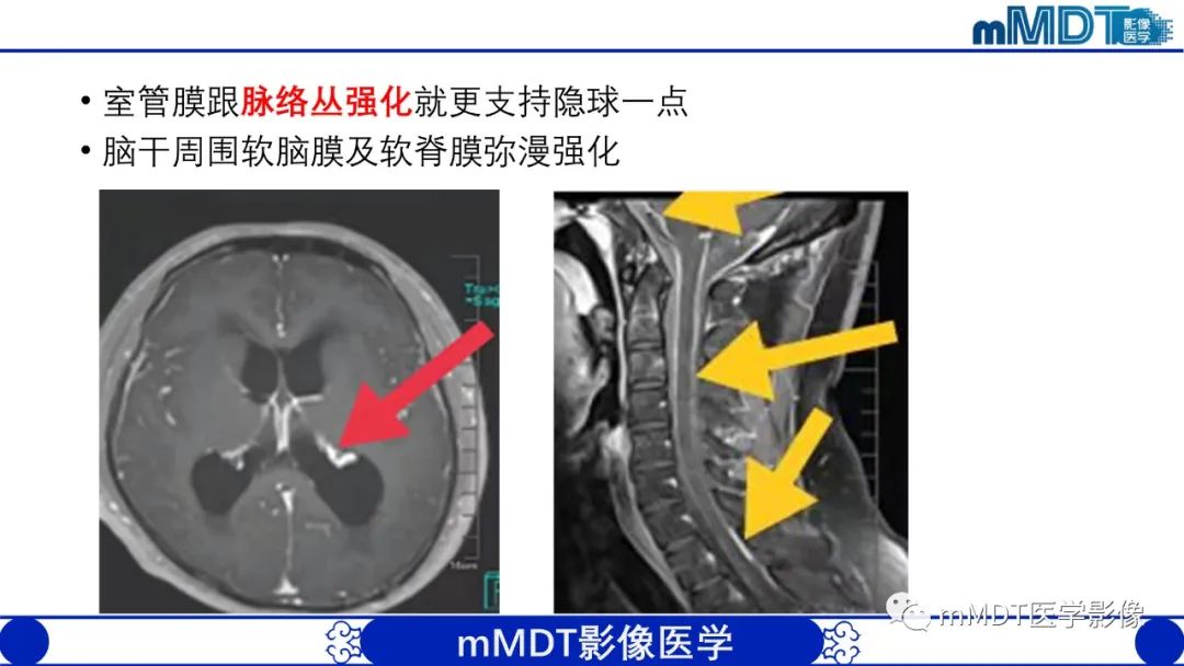 影像PPT - 【PPT】两例脑膜强化的隐球菌及综述-35