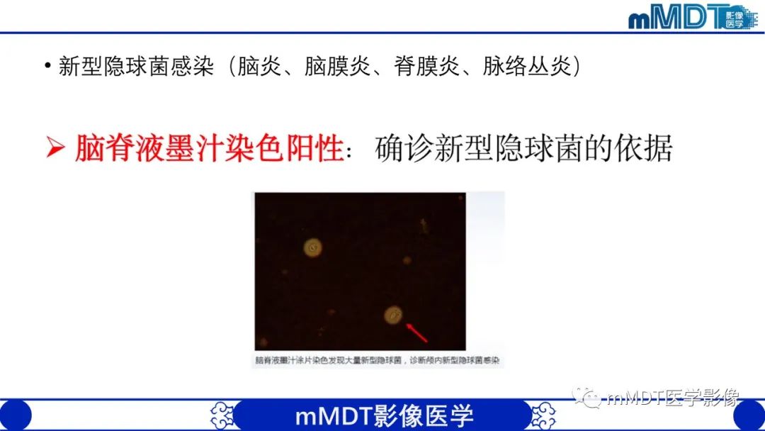影像PPT - 【PPT】两例脑膜强化的隐球菌及综述-38