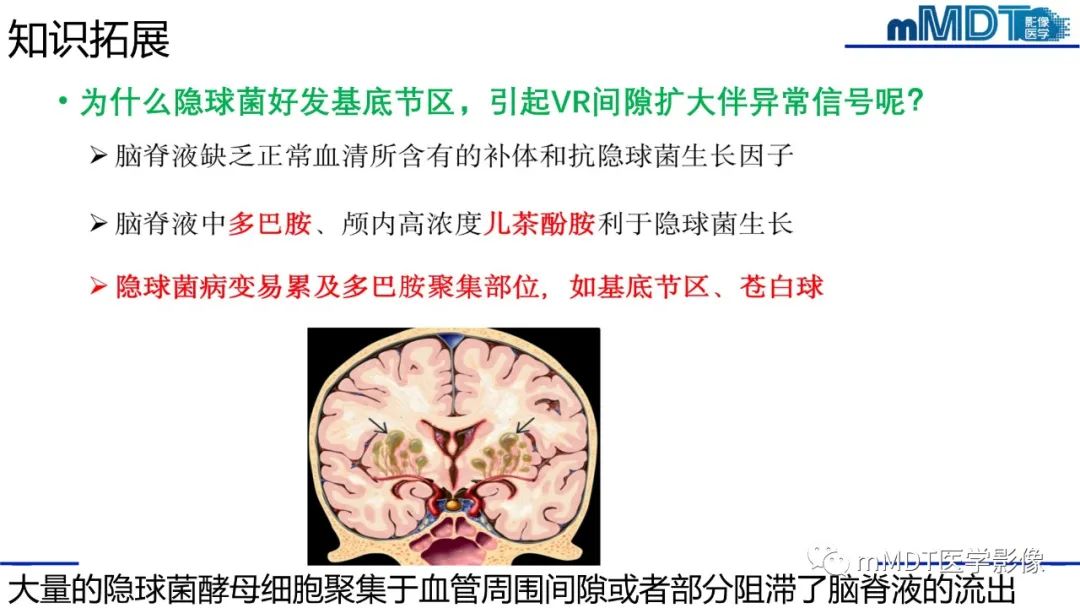 影像PPT - 【PPT】两例脑膜强化的隐球菌及综述-39