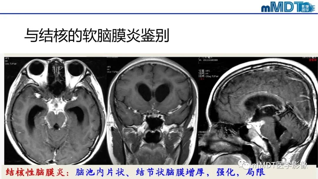 影像PPT - 【PPT】两例脑膜强化的隐球菌及综述-41