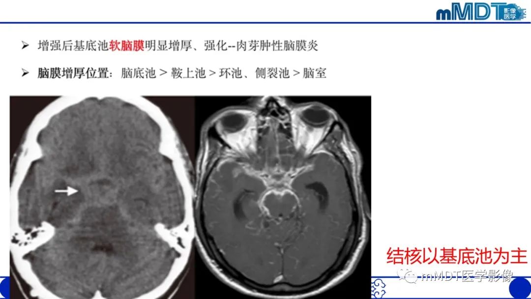 影像PPT - 【PPT】两例脑膜强化的隐球菌及综述-42