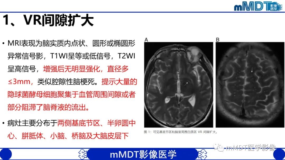 影像PPT - 【PPT】两例脑膜强化的隐球菌及综述-45