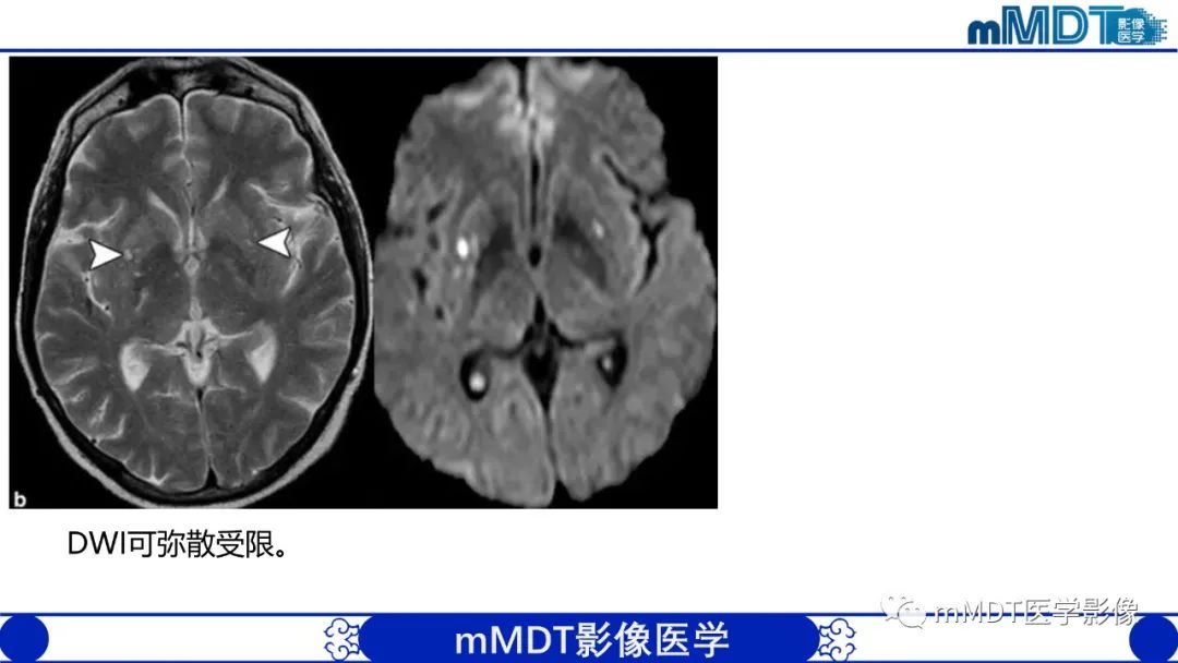 影像PPT - 【PPT】两例脑膜强化的隐球菌及综述-49