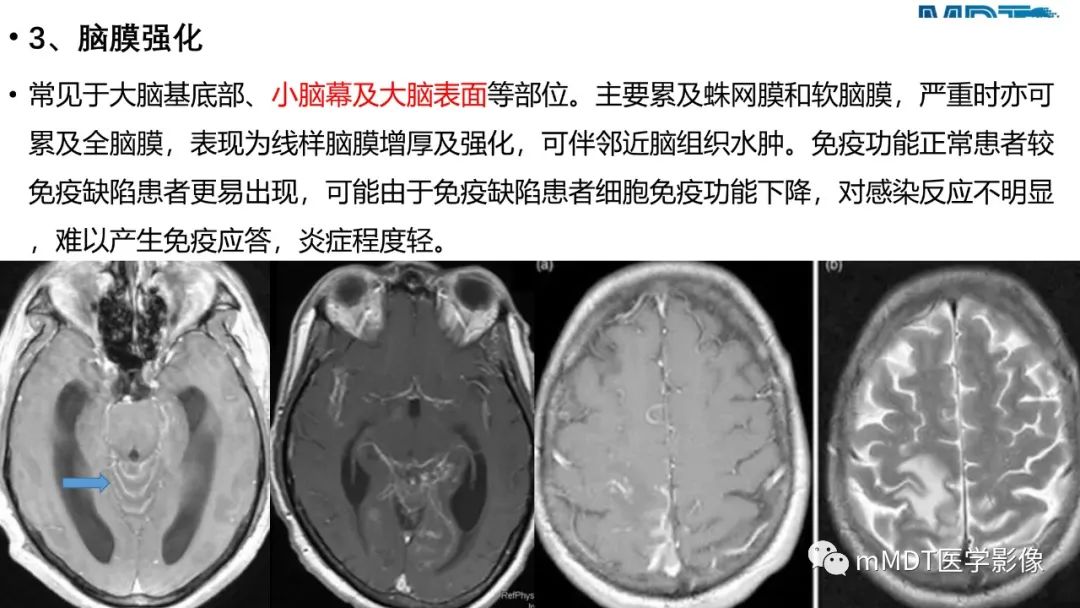 影像PPT - 【PPT】两例脑膜强化的隐球菌及综述-50