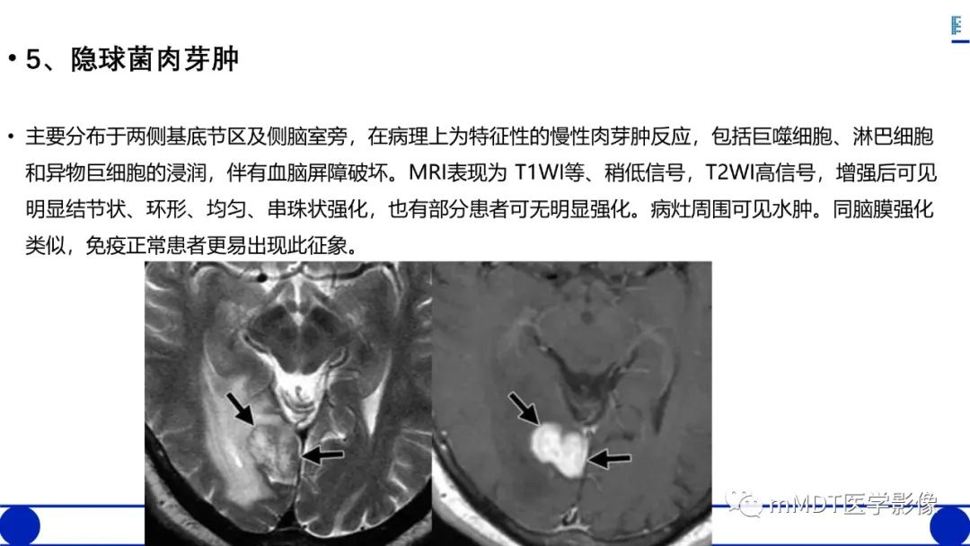 影像PPT - 【PPT】两例脑膜强化的隐球菌及综述-52
