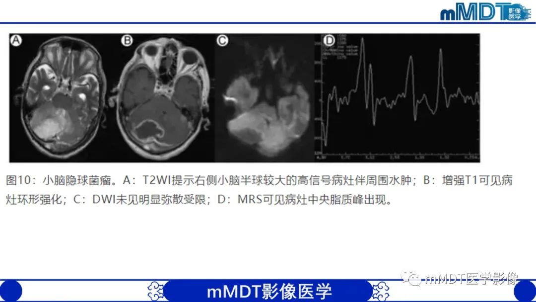 影像PPT - 【PPT】两例脑膜强化的隐球菌及综述-53