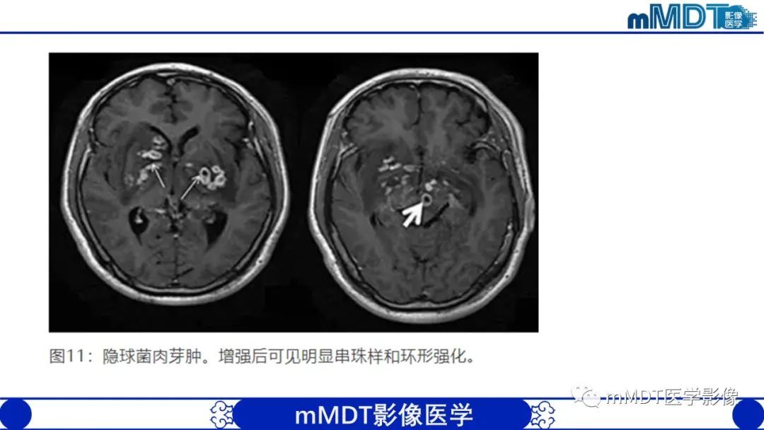 影像PPT - 【PPT】两例脑膜强化的隐球菌及综述-54