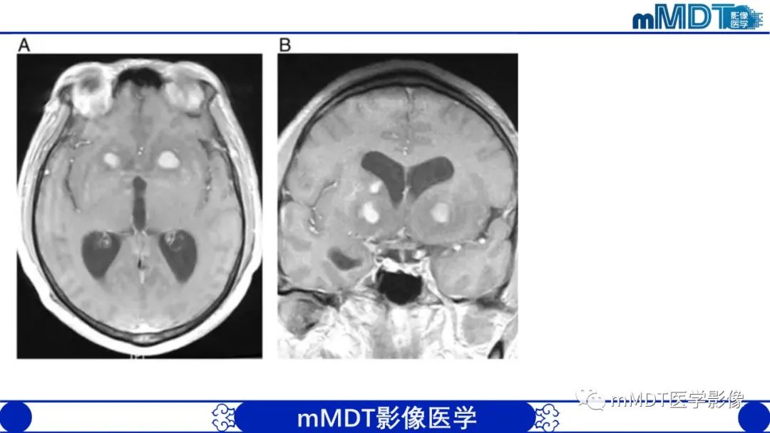 影像PPT - 【PPT】两例脑膜强化的隐球菌及综述-55
