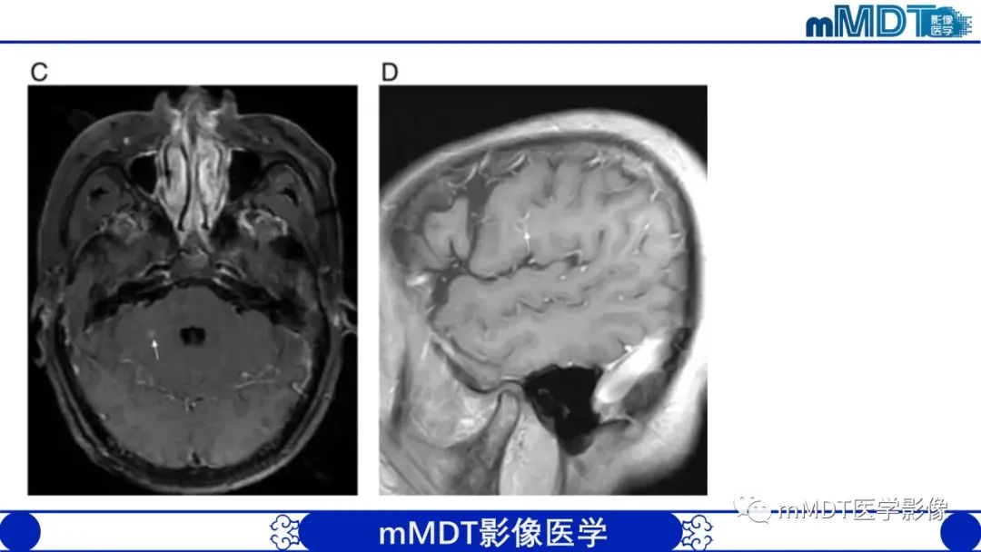 影像PPT - 【PPT】两例脑膜强化的隐球菌及综述-56