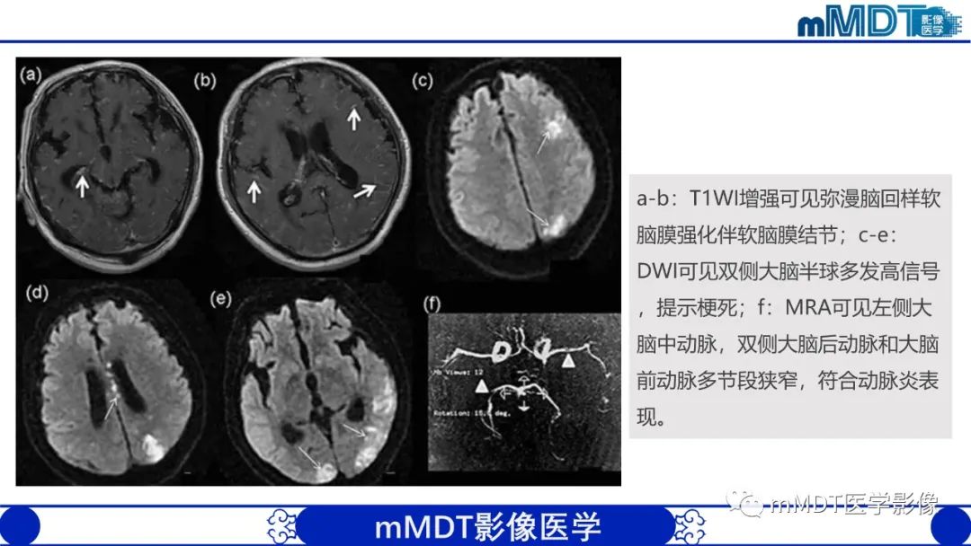 影像PPT - 【PPT】两例脑膜强化的隐球菌及综述-58