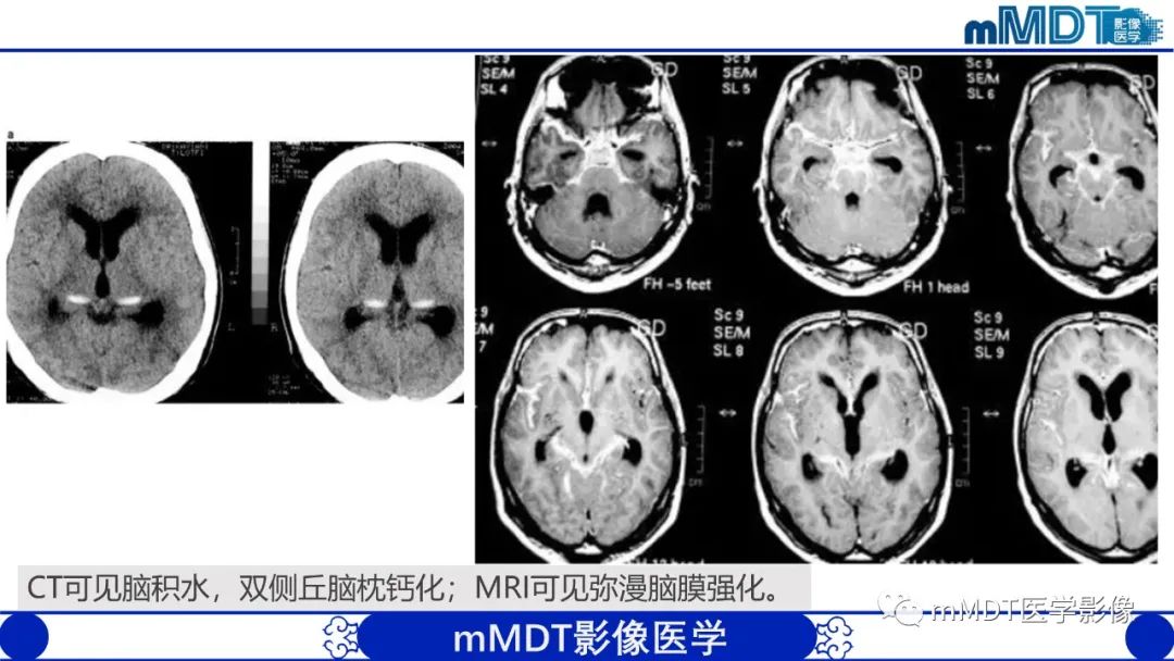 影像PPT - 【PPT】两例脑膜强化的隐球菌及综述-59