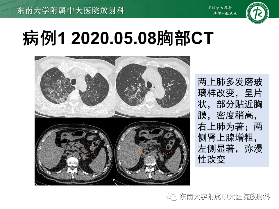 影像PPT - 【PPT】血管内大B细胞淋巴瘤-5 影像PPT - 【PPT】血管内大B细胞淋巴瘤-5