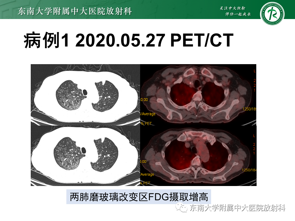 影像PPT - 【PPT】血管内大B细胞淋巴瘤-9 影像PPT - 【PPT】血管内大B细胞淋巴瘤-9