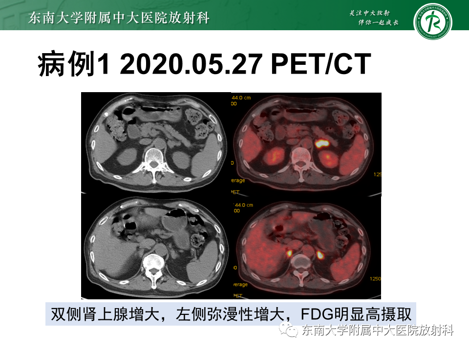 影像PPT - 【PPT】血管内大B细胞淋巴瘤-10 影像PPT - 【PPT】血管内大B细胞淋巴瘤-10
